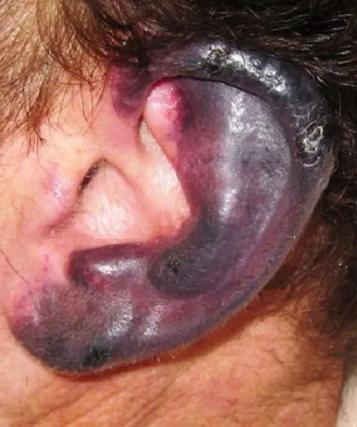 necrotic lesions